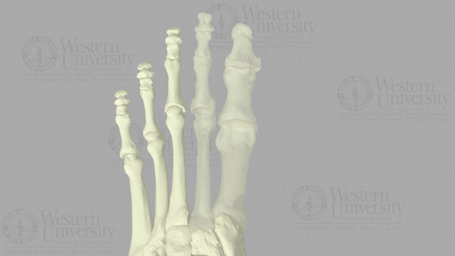 Weil Osteotomy 3D Model By WesternU3D 17422f1 Sketchfab