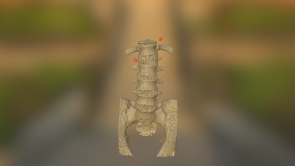 Transpedicular Screw Placement Of Spine 3D Model By Juan Arias