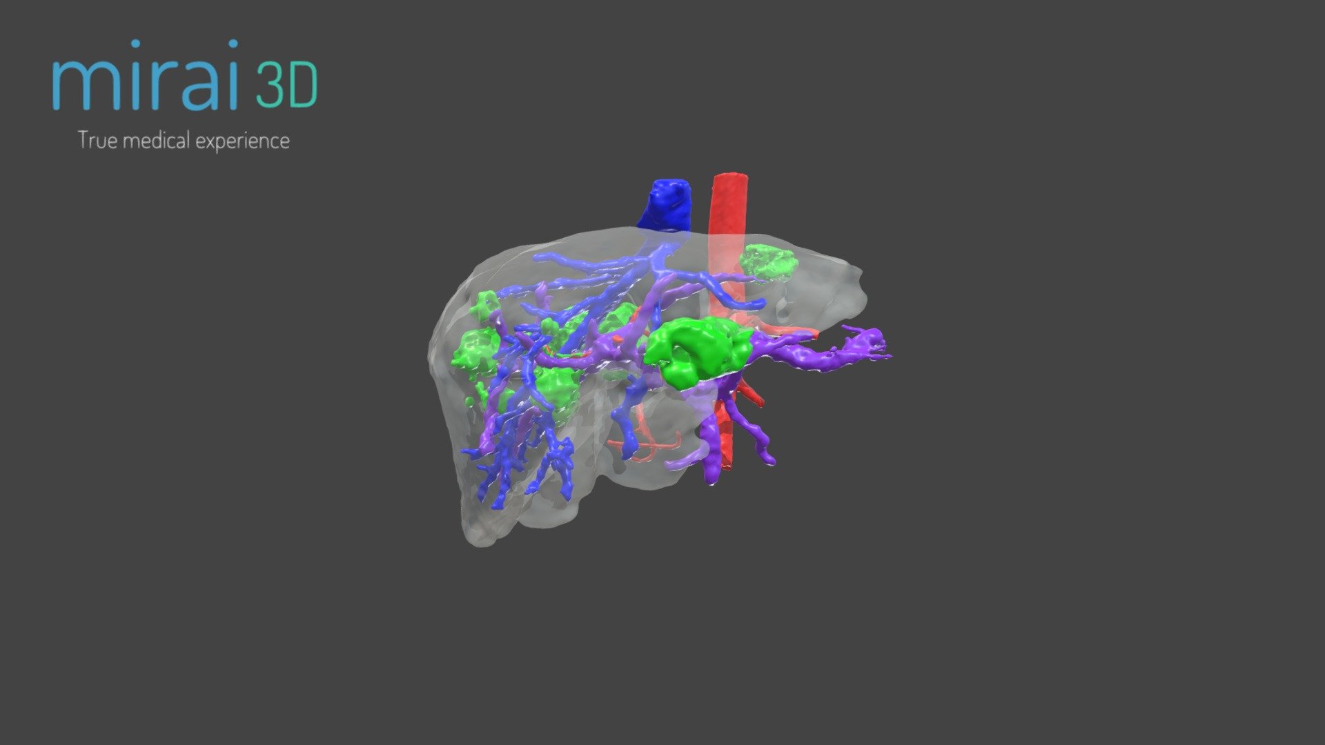 D Model For Hepatectomy Surgical Planning D Model By Mirai D