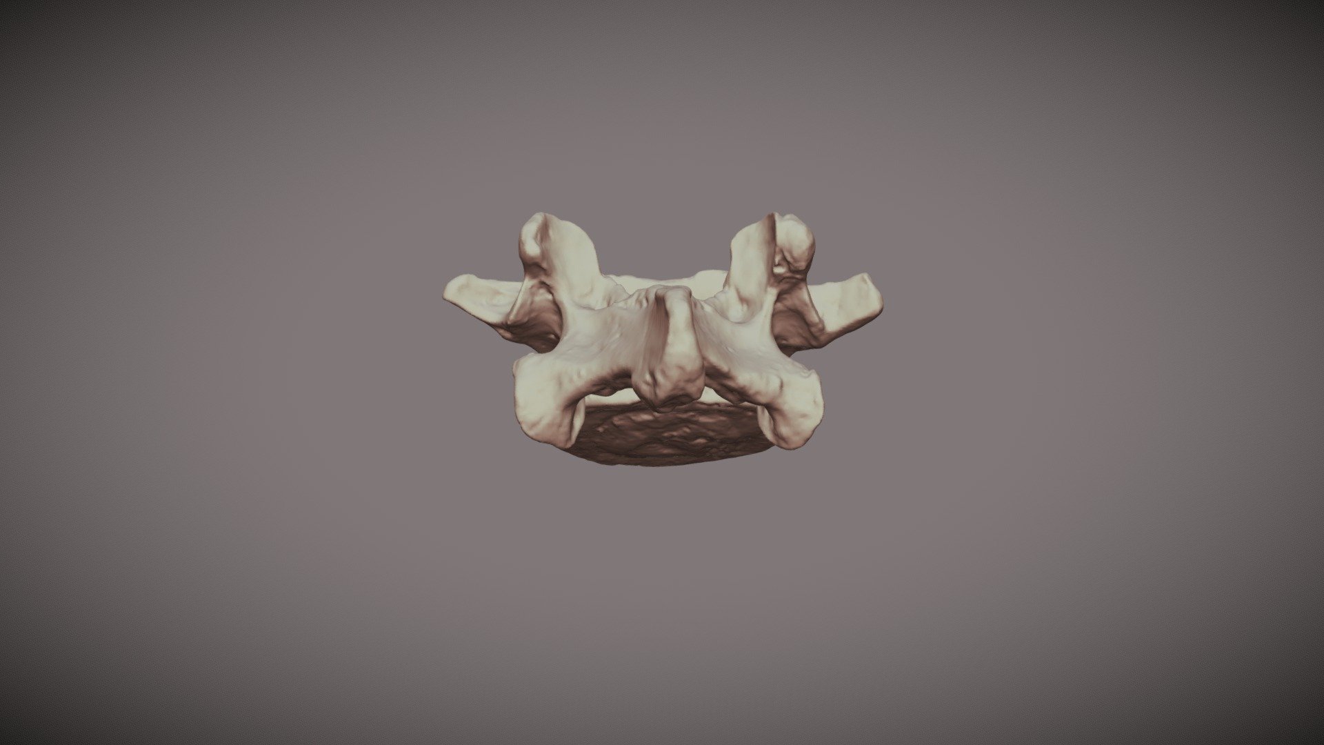 Lumbar Vertebra Example 3D Model By OrJames Labs Orjameslabs