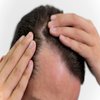 Avatar of Hair transplant in Riyadh