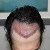 Avatar of Hairtransplant7712