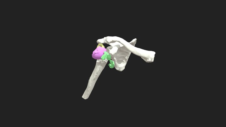 3D0045_10041151_rsa_fractura 3D Model
