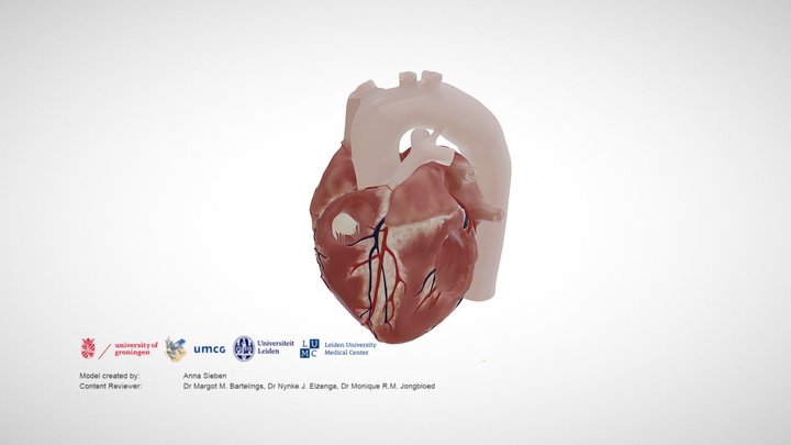 Tetralogy of fallot