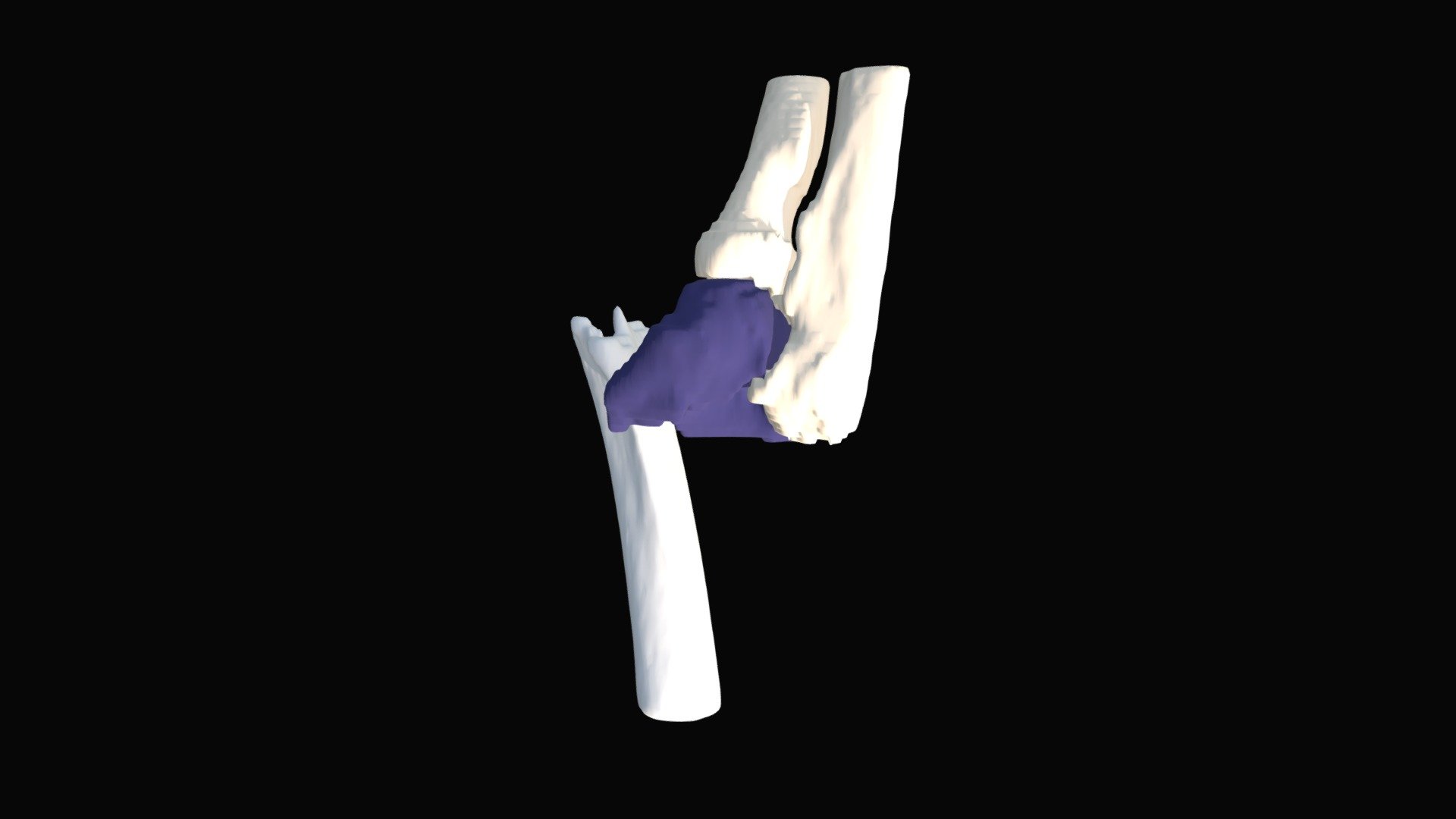 Session 4.10 | Distal Humerus | 1 CGN