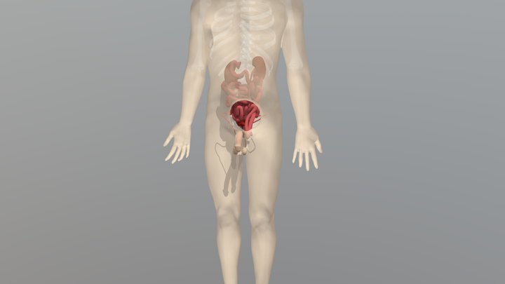 Hernia Nguinalis 3D Model