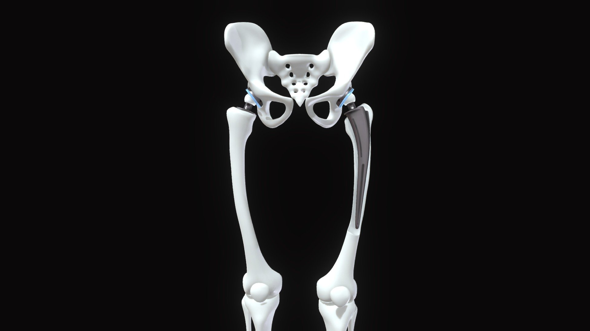 Hip Replacement Implant Bone Legs