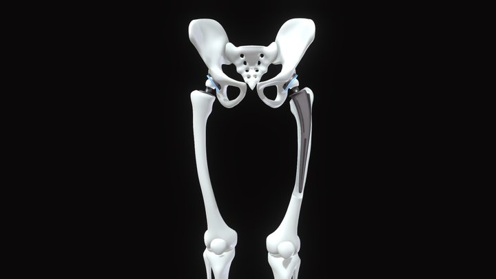 Hip Replacement Implant Bone Legs 3D Model