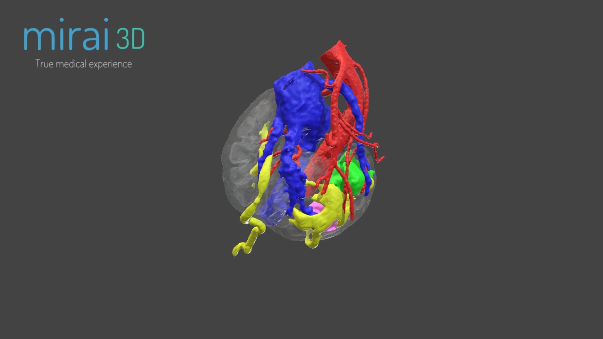 Uro-Oncology 3D Surgical Planning