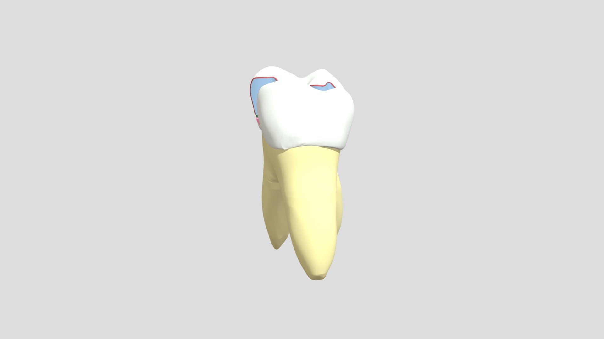 Cavidade Classe II – MOD – Dente 16