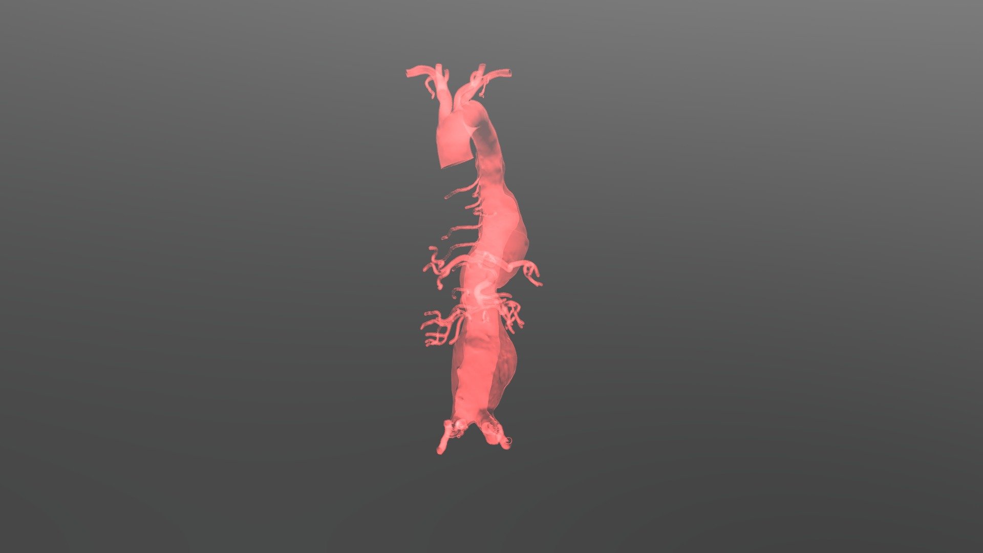Thoracoabdominal Aortic Aneurysm type II - 3D model by valchanov ...