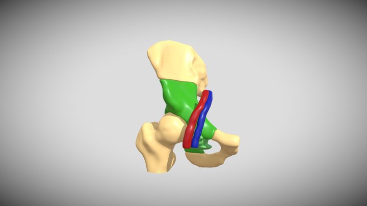 PELVIStumorFEMURartVEN 3D Model