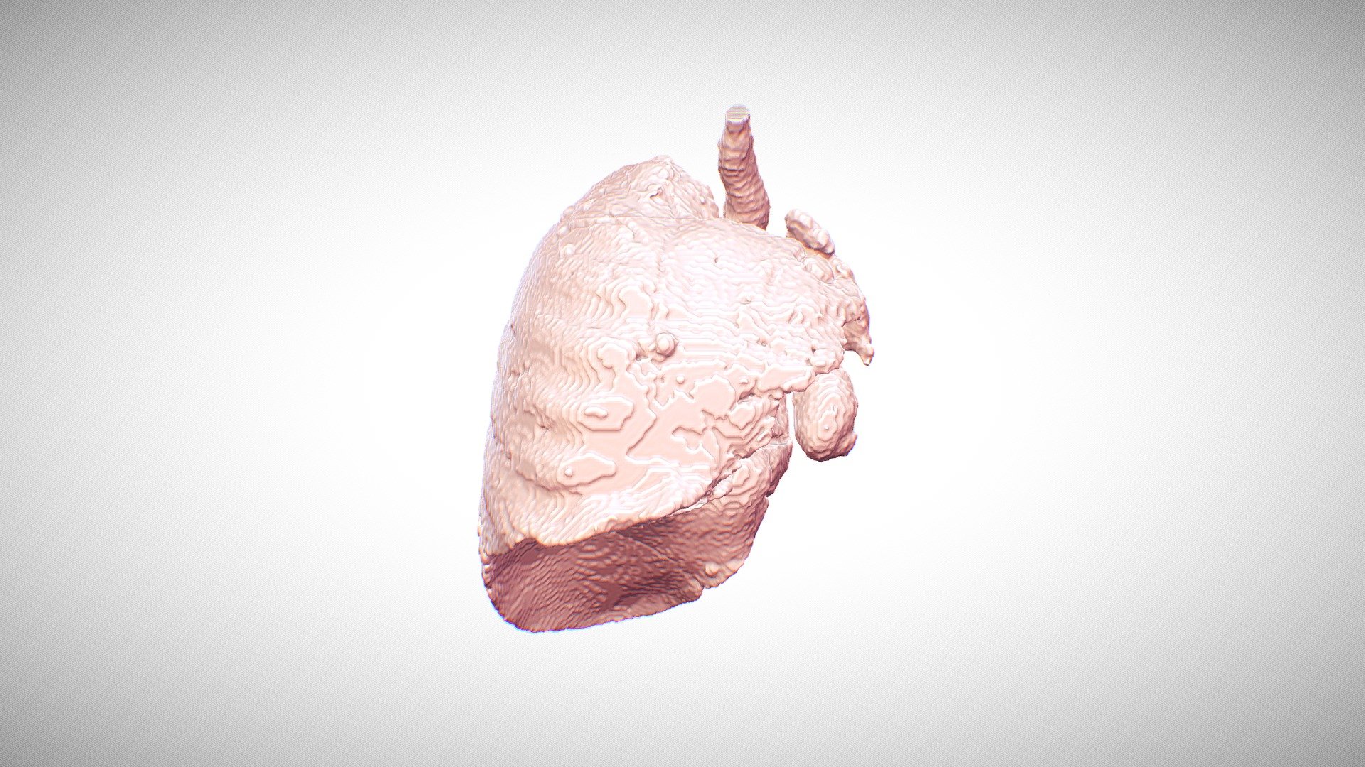 Tubercular Destroyed Lung