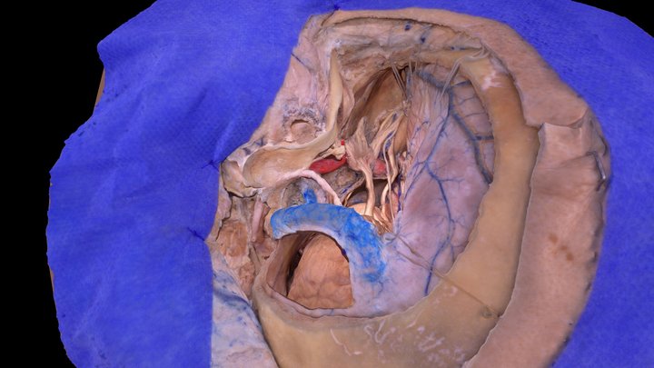 Combine Petrosal Total Petrosectomy 3D Model