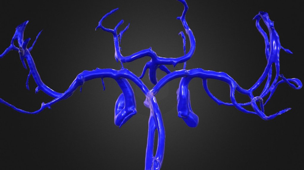 Normal cerebral arteries N001