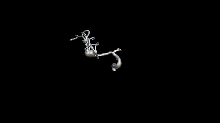 Aneurisma ACM derecha 3D Model