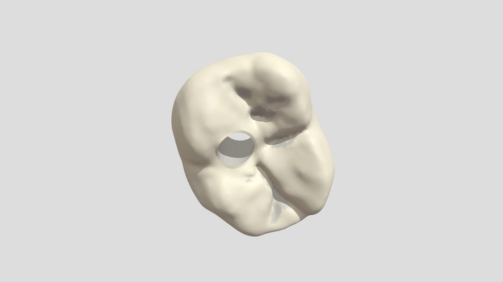 Couronne Sur Implant 3D Model