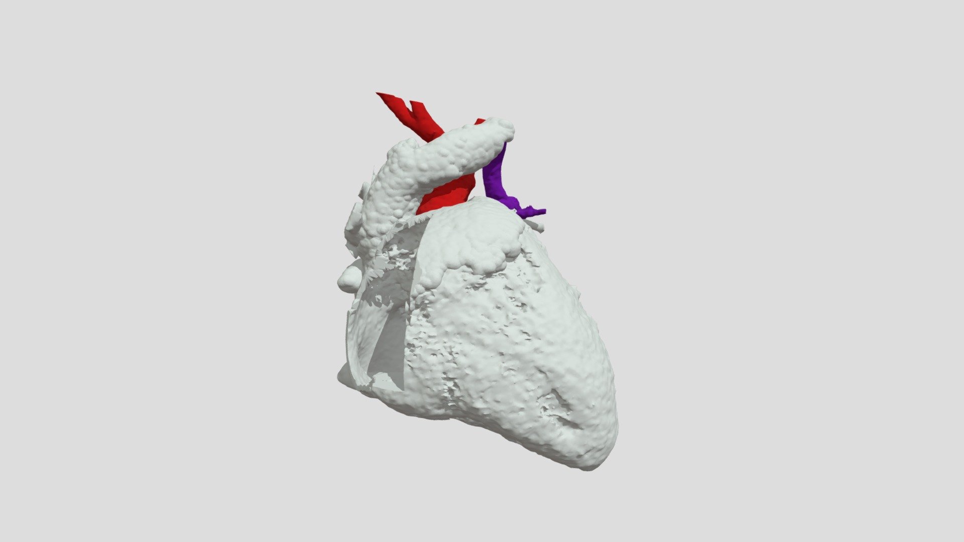 Superior Sinus Venosus Defect With Papvr S D Model By Nch