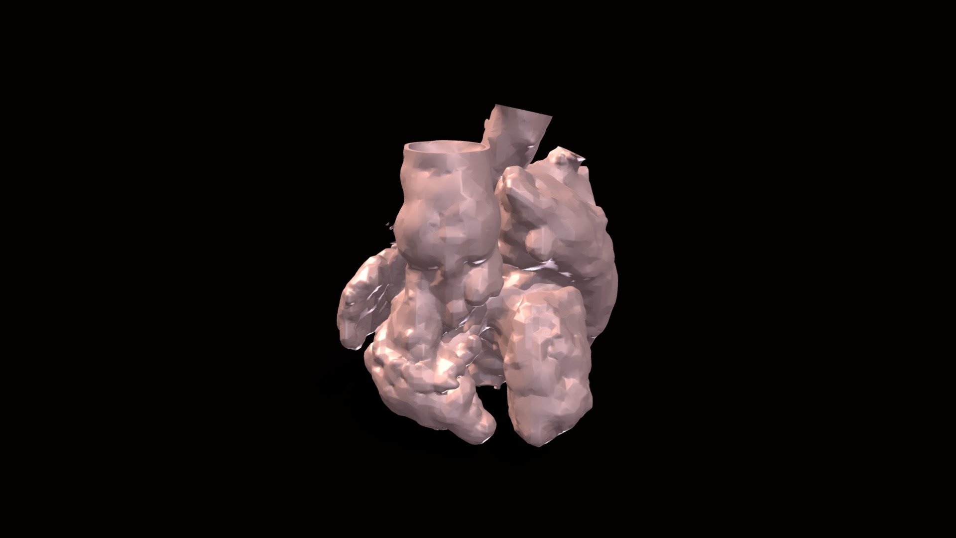 Atrial situs inversus, double discordance, PA