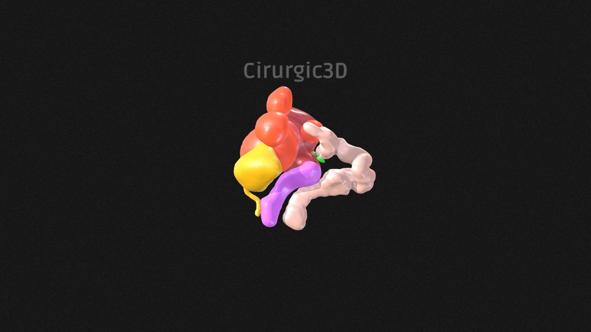 Fibroids and endometriosis - Download Free 3D model by Cirurgic3D ...