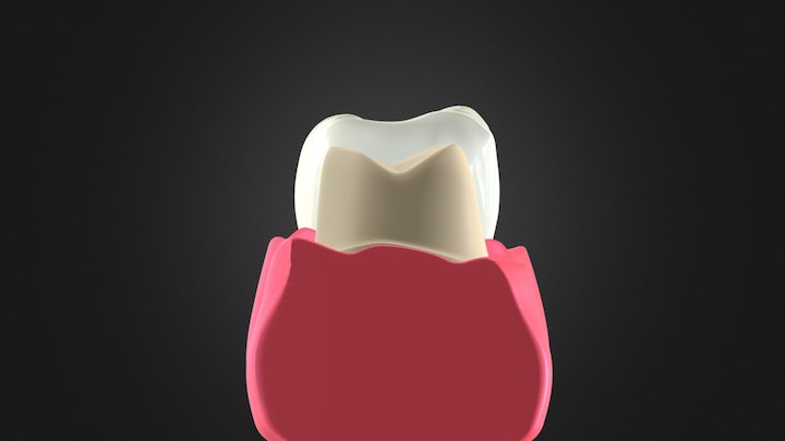 Crown Preparation 3D Model