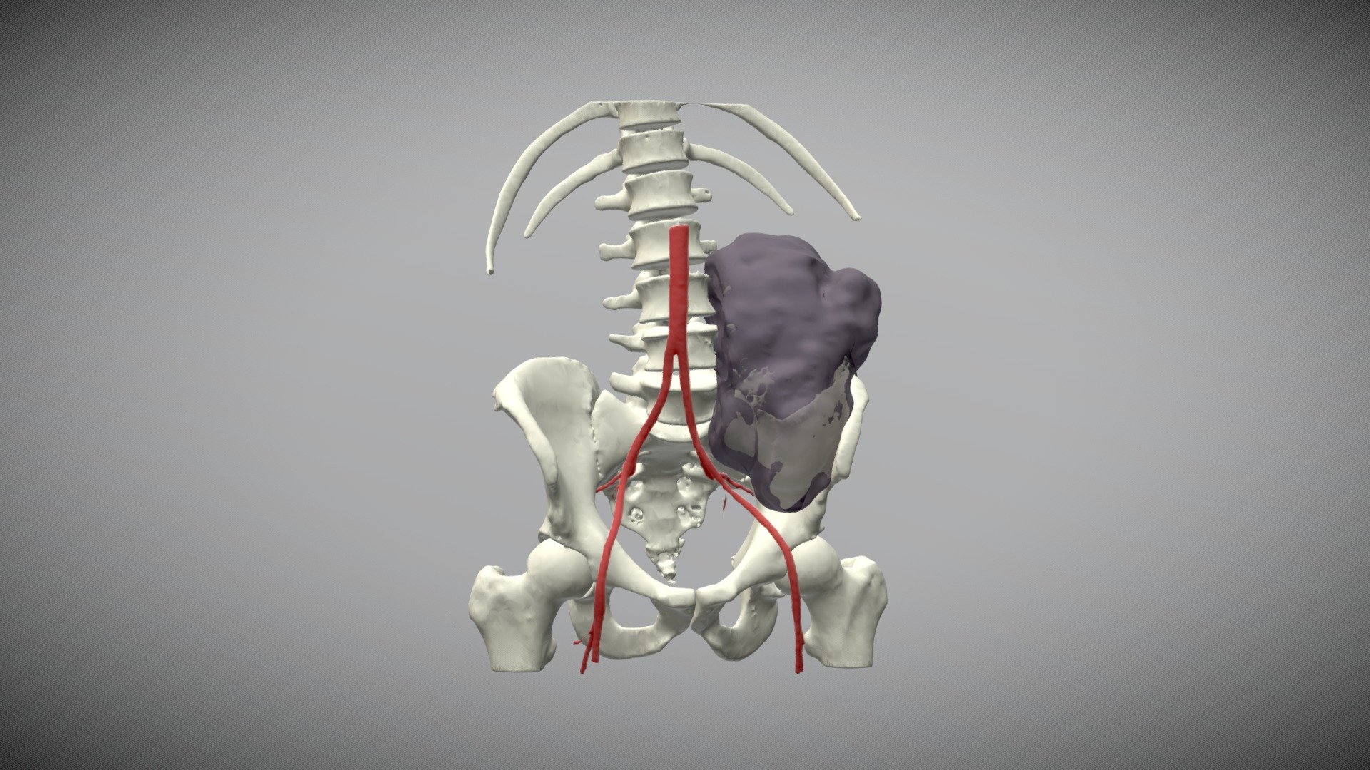 Pelvic Bone Cancer 3d Model By Mostafa Meleis Mmeleis 0455875 Sketchfab