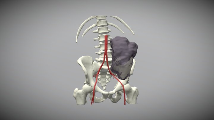 Pelvic Bone Cancer 3D Model