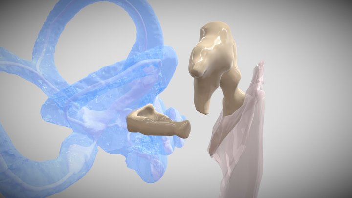 Ossicular Chain Reconstruction with a PORP 3D Model