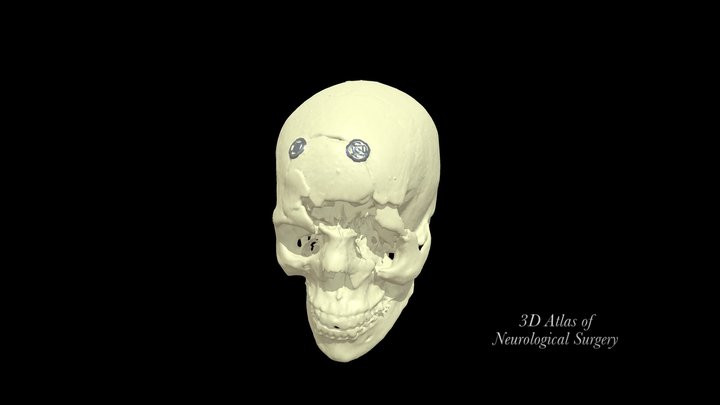 Complex craniofacial trauma 3D Model