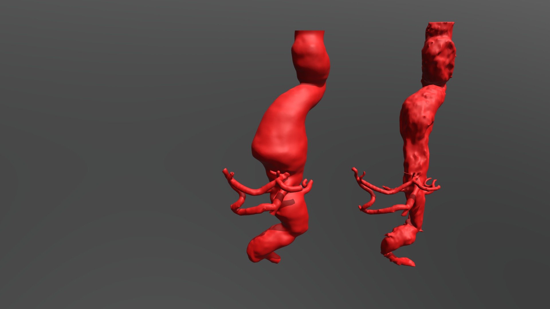 Thoracoabdominal aortic aneurysm - 3D model by valchanov [04899ec ...