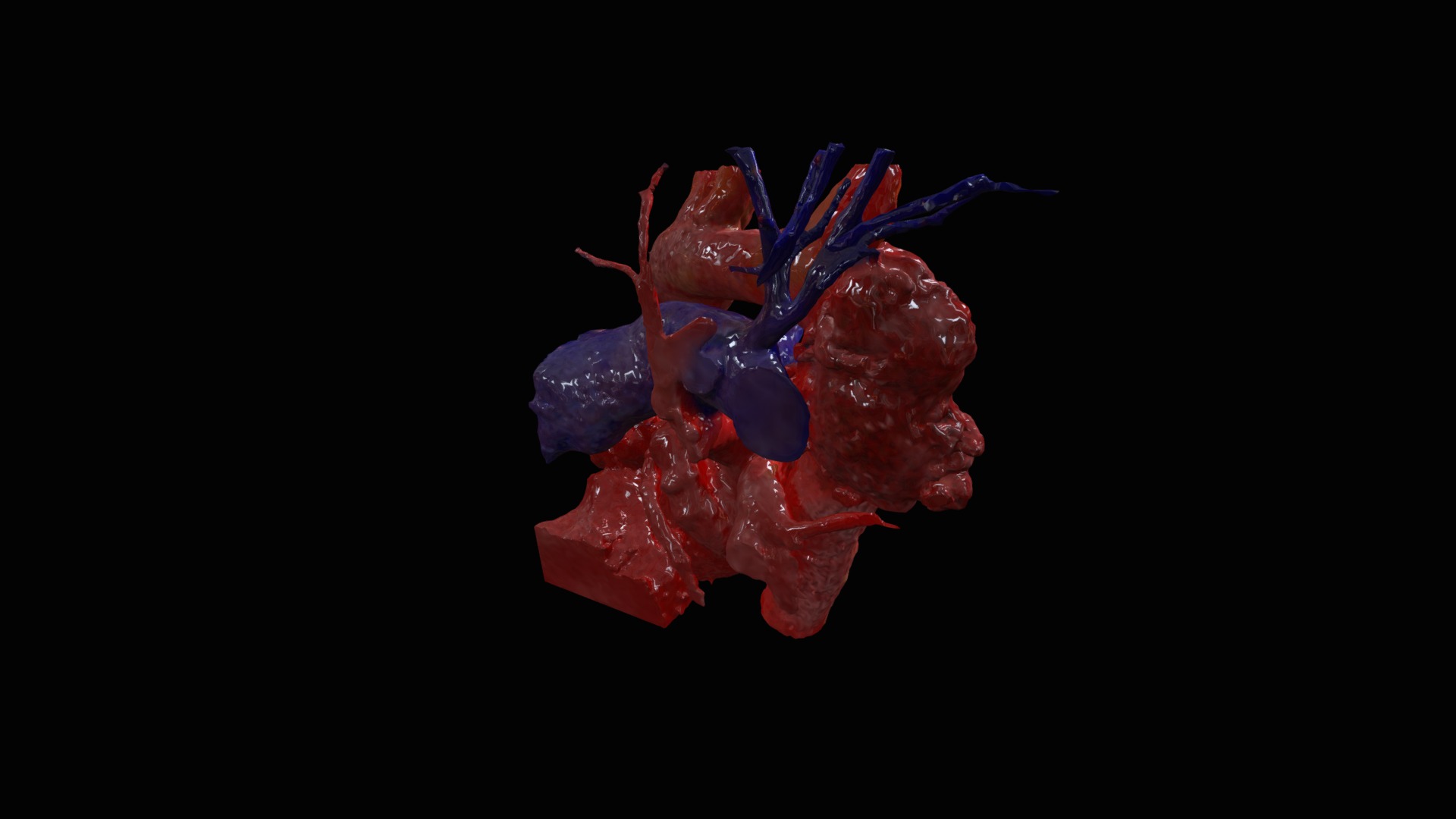 Aortic Pseudoaneurysm - 3D model by tl0615 [0529446] - Sketchfab