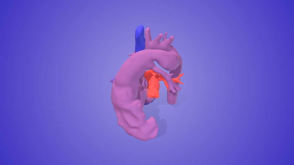 Hypoplastic Left Heart Syndrome (HLHS)
