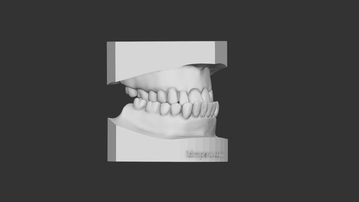Maloclusion Clase III 3D Model
