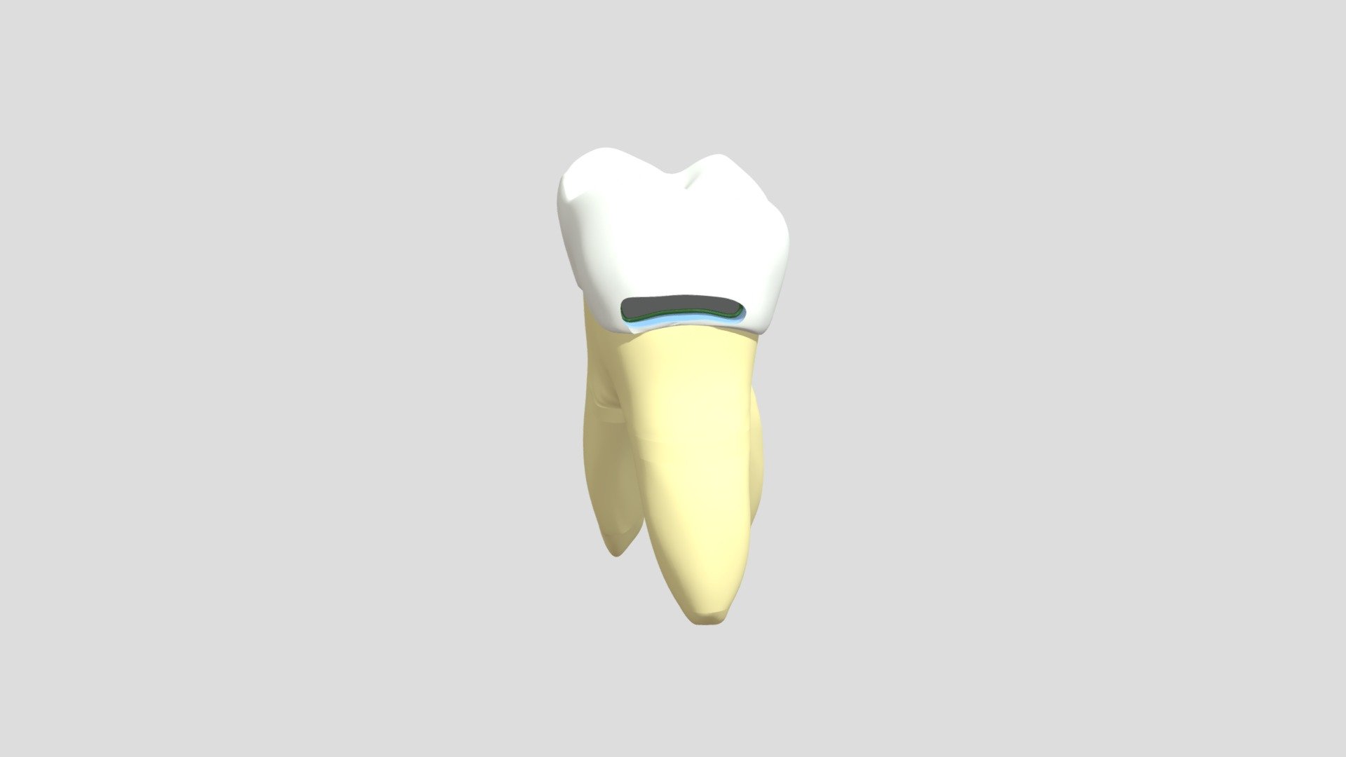 Cavidade Classe V – Dente 16