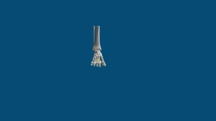 Neuroma 3D Model