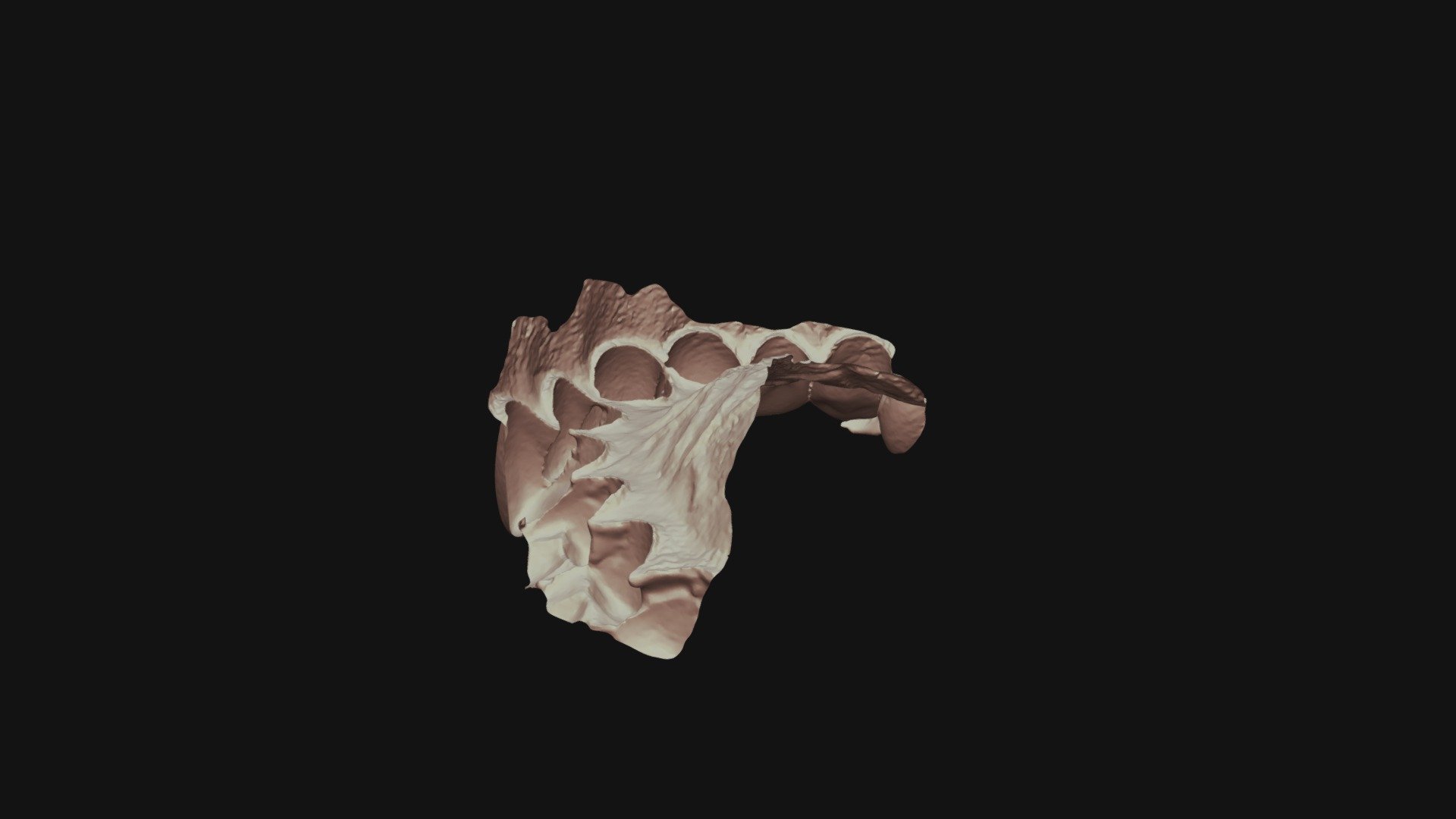 Group 3 - Tooth #9 - Class 3 Prep (2)