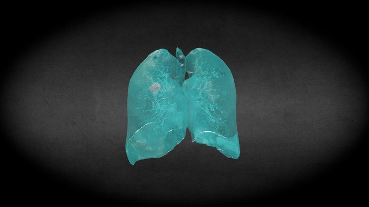 Lung Tumor Segmentation 3D Model