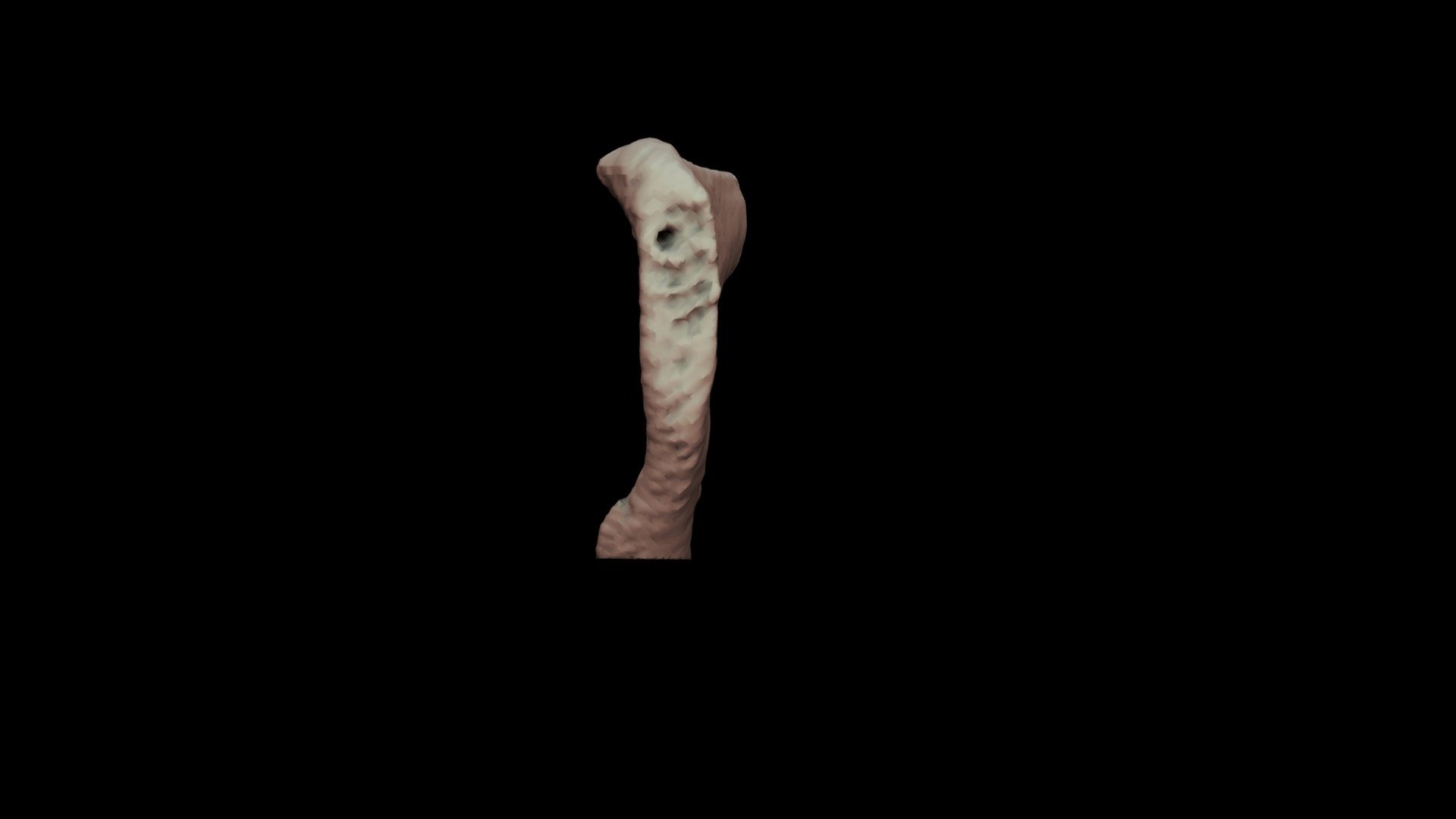 Pubic Symphysis Male 18yo