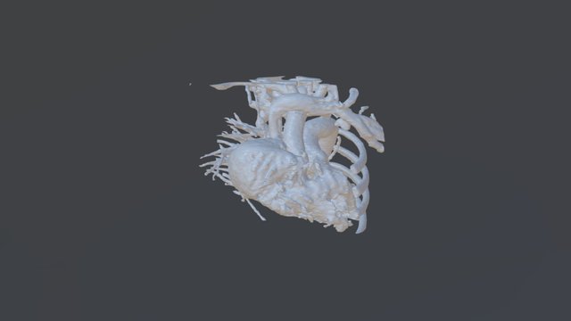 DORV/MA TAPVR Preop 3D Model