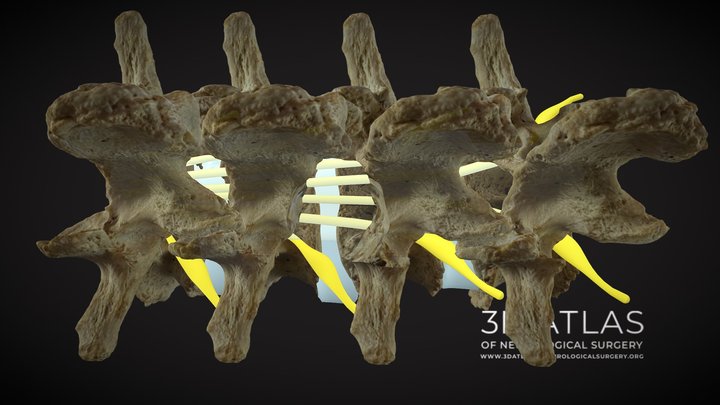 Lumbar facetectomy 3D Model