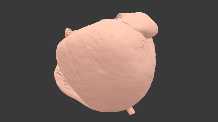 AS #2 - Hypo LV, severe AS, ASD 1, muscular VSD 3D Model