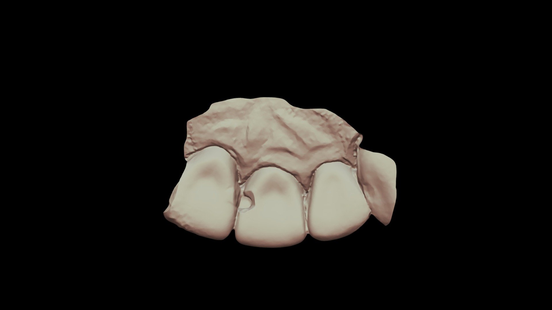 #8 Class3, Group8, Scanner6 Upper Jaw