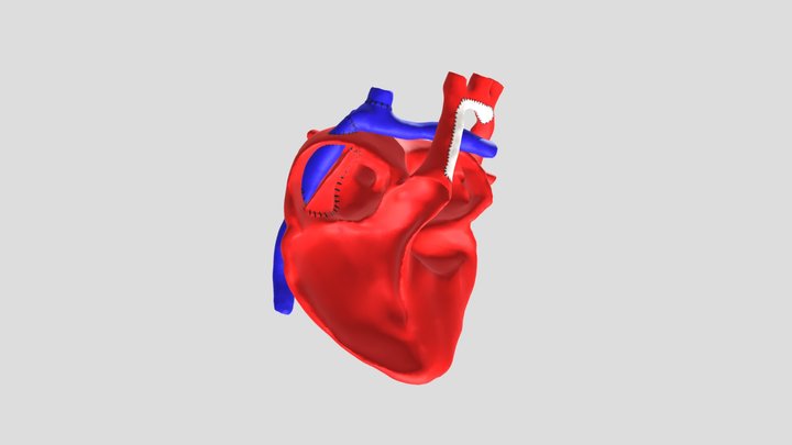 Intracardiac Post Fontan Model 3D Model