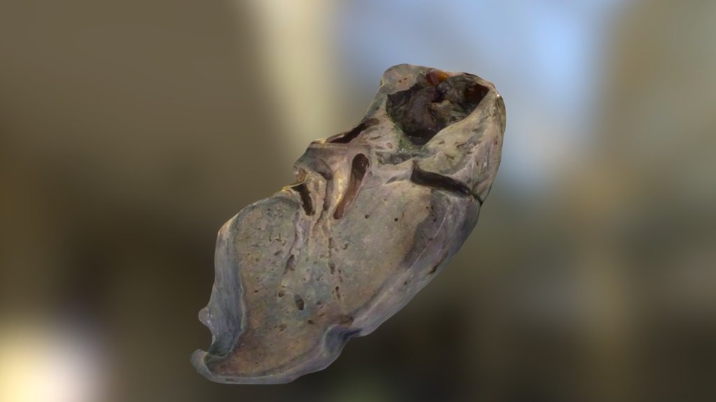 Aspergilloma, lung