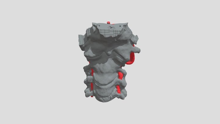 AAD with aberrant VA 3D Model