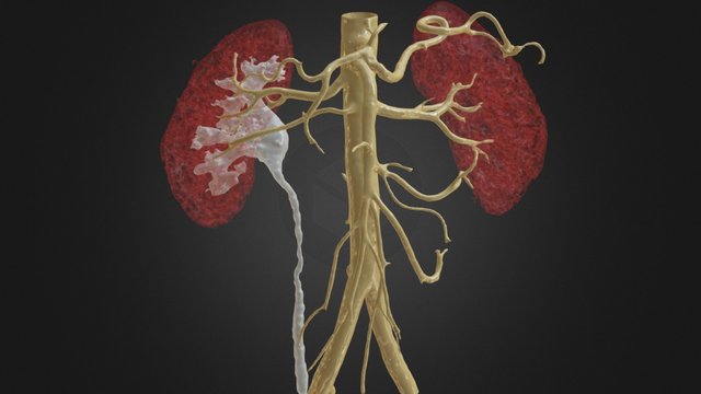 Malformacion Vascular Renal 3D Model