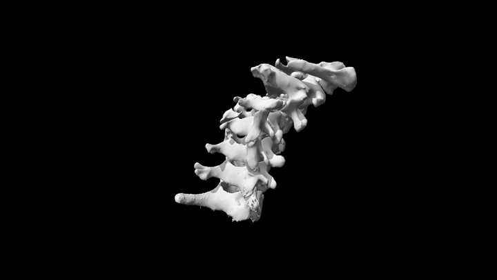 Cervical vertebrae showing trauma 3D Model