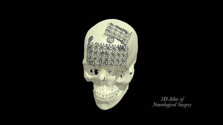 Postoperative reconstruction craniofacial trauma 3D Model