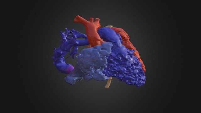 Malformacion Cardiaca Congenita 3D Model