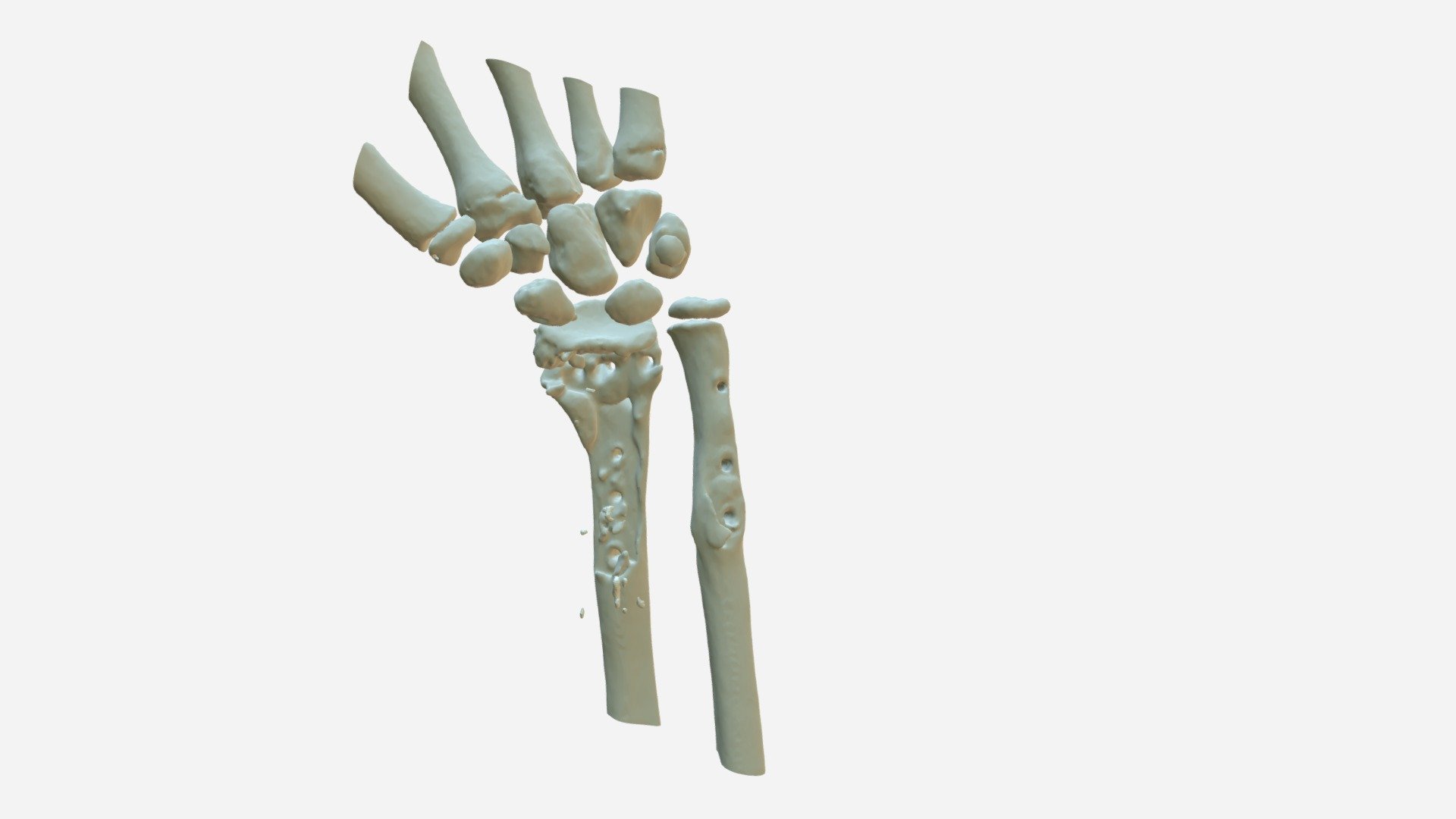 P00020 Radius & Ulna pathology